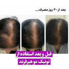 تونیک اورجینال اصل کاهش ریزش مو و محرک سرعت رشد مو تقویت کننده مو ۳۰۰ میل ارسال مستقیم از شرکت ایرانیان زمین