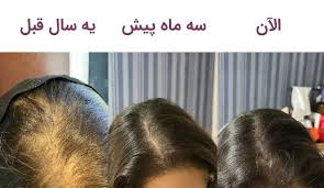 تونیک اورجینال اصل کاهش ریزش مو و محرک سرعت رشد مو تقویت کننده مو ۳۰۰ میل ارسال مستقیم از شرکت ایرانیان زمین