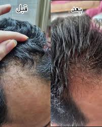 خرید عمده 20عددی تونیک رشد مو اصل تضمینی ۳۰۰ میل ارسال مستقیم از شرکت ایرانیان زمین